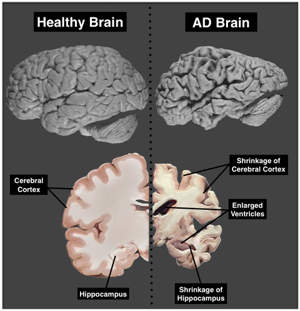 Alzheimer hastası insanın beyni