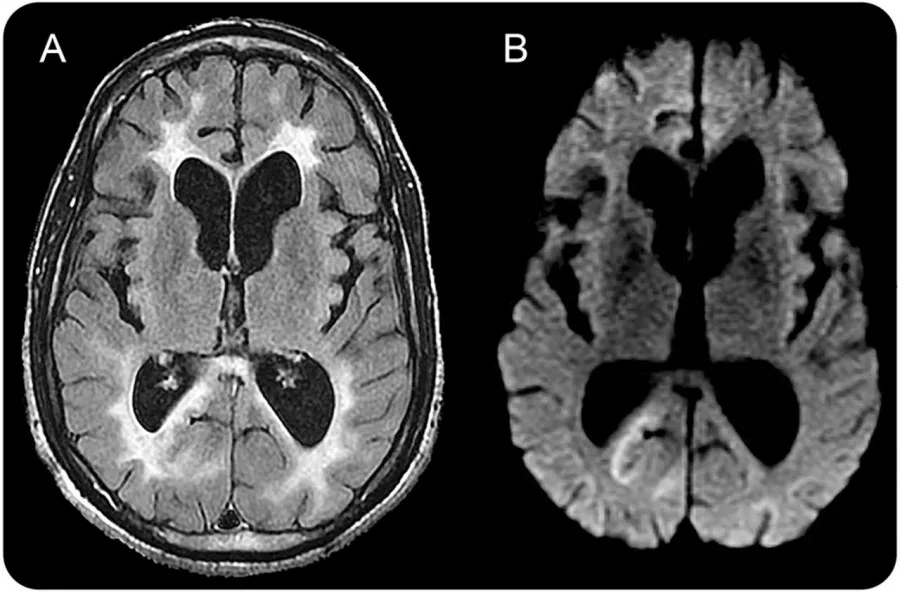 subakut sklerozan panensefalitli beyin